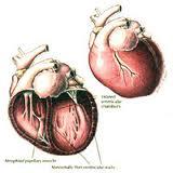 Dilated cardiomyopathy (DCM). 